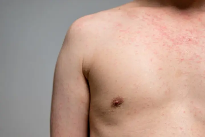 Eruzione cutanea rossa sul petto e sulla spalla, forse causata da un tessuto sintetico. L'elastan fa male alla pelle sensibile.