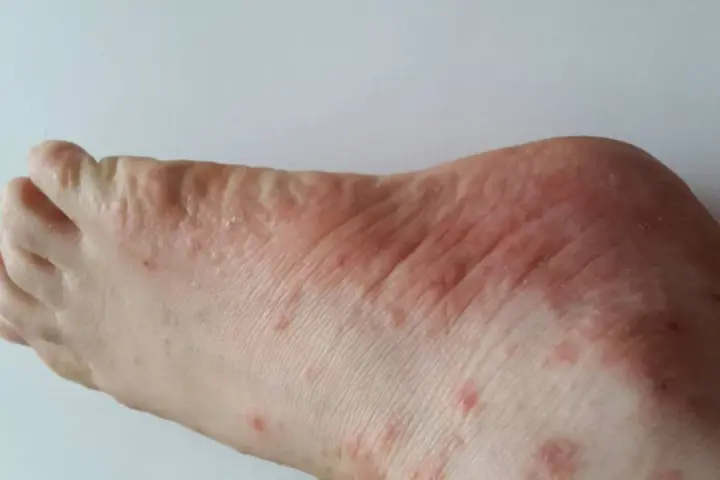 Pied rouge et irrité, avec des petites bosses et des zones sèches, signe d'un pied qui gratte.