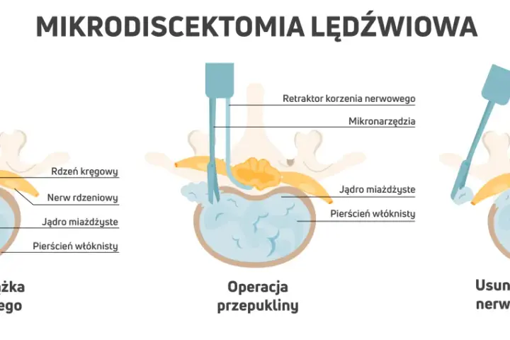 Ilustracja pokazuje mikrodiscektomię lędźwiową: przepuklinę, operację i usunięcie fragmentu krążka. Pamiętaj, czego nie wolno robić po operacji kręgosłupa lędźwiowego.