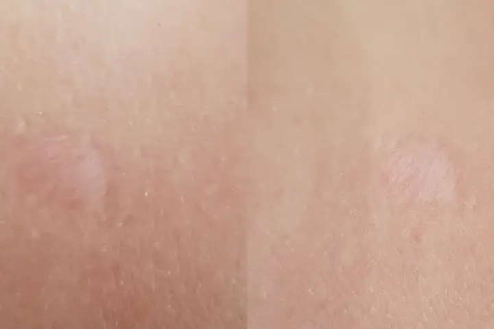 Jasna skóra z widocznymi, lekko zaróżowionymi bliznami po depilacji laserowej.