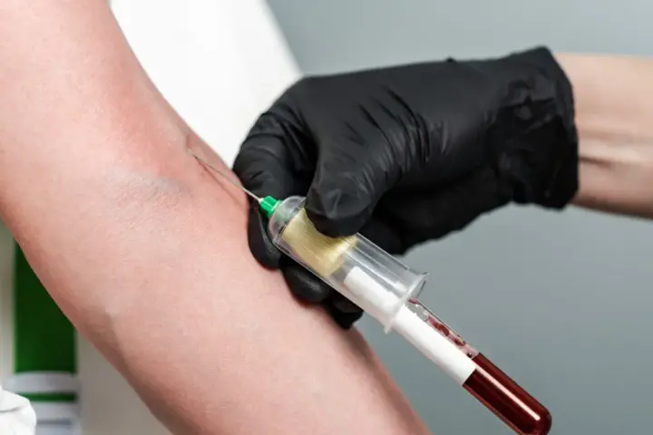 Wysoka ferrytyna: przyczyny, objawy nadmiaru żelaza. Kiedy do lekarza?
