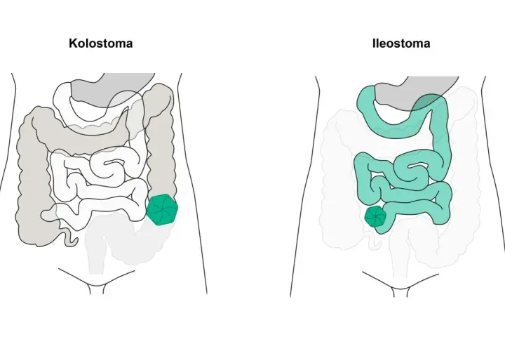 Vergleich von Kolostoma und Ileostoma: zwei stoma arten, die den Darm betreffen.