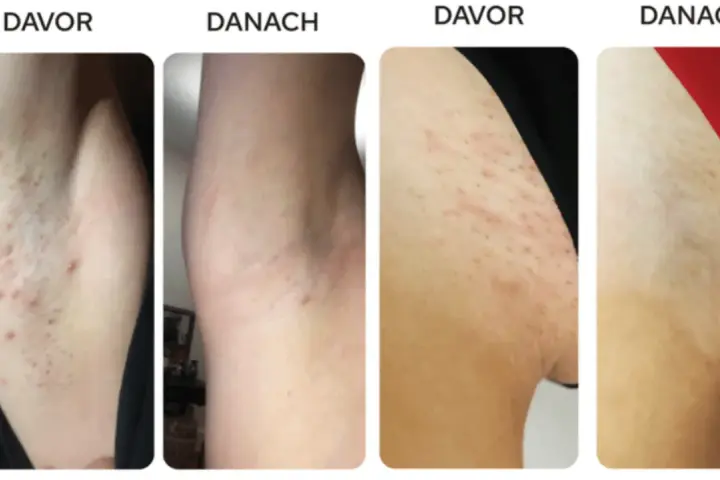 Vorher/Nachher-Bilder zeigen Achseln mit Pickeln nach dem Rasieren. Nach der Anwendung ist die Haut glatter, was zeigt, wie man rasieren ohne Pickel kann.