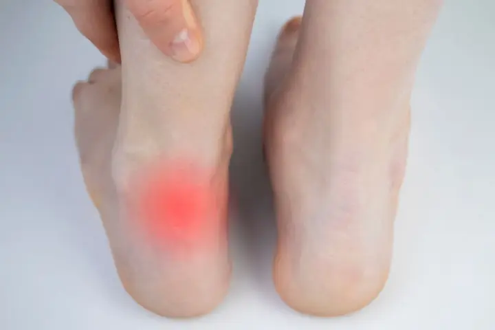 Ból pięty z zaczerwienieniem, sugerujący zrosty po operacji ścięgna Achillesa.