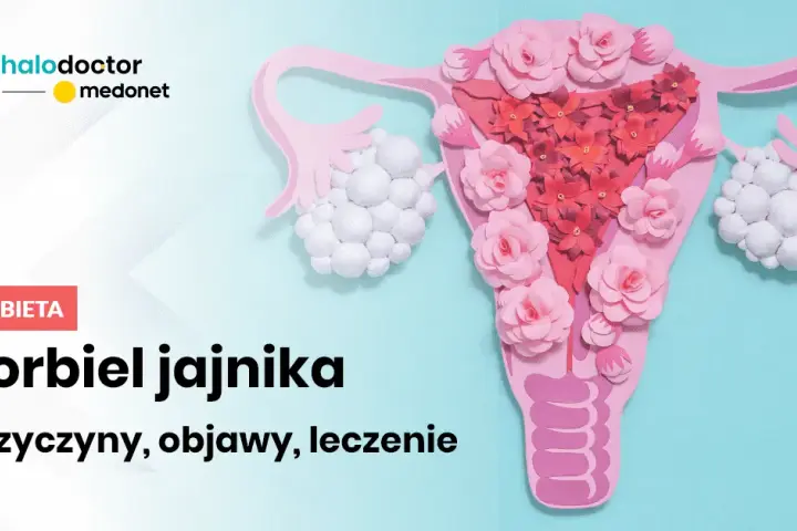 Jakie leki hormonalne na torbiel jajnika mogą skutecznie pomóc?
