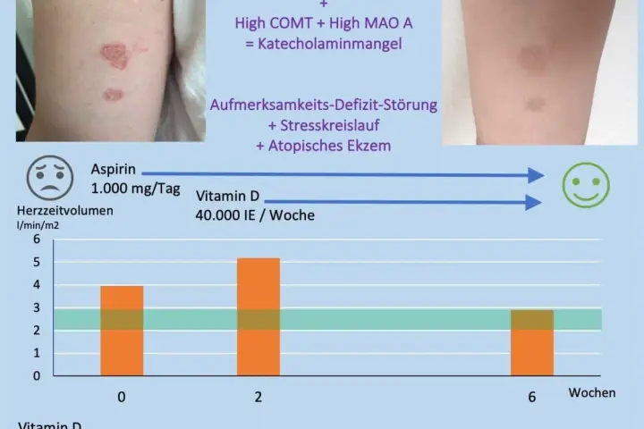 Vitamin D Mangel Symptome bei Erwachsenen: Erfahrungsberichte und Anzeichen