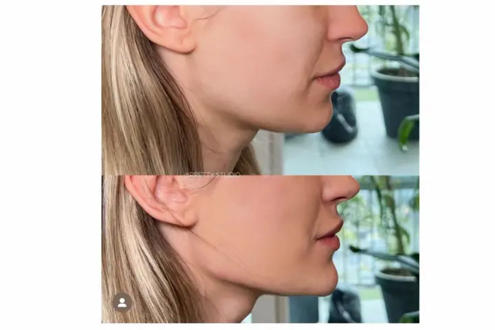 Endermologia twarzy: Lifting bez skalpela? Sprawdź efekty!