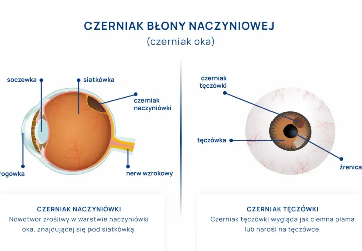 Schemat oka z zaznaczonym czerniakiem naczyniówki i czerniakiem tęczówki.