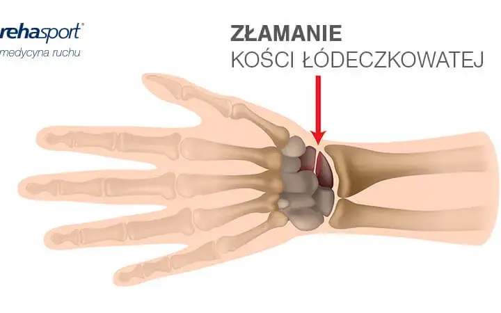 Boli nadgarstek? Skręcenie czy złamanie? Rozpoznaj i pomóż sobie