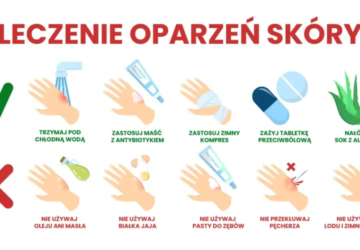 Leczenie oparzeń skóry: chłodna woda, maść z antybiotykiem, zimny kompres, tabletki przeciwbólowe, sok z aloesu. Unikaj masła, jajka, pasty do zębów, przekłuwania pęcherzy, lodu.