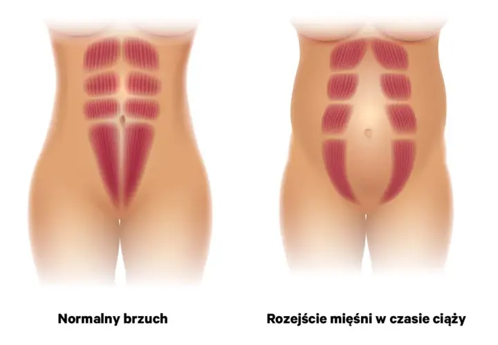 Ilustracja porównuje normalny brzuch z rozejściem mięśni brzucha w czasie ciąży, pokazując rozdzielenie mięśni prostych brzucha.