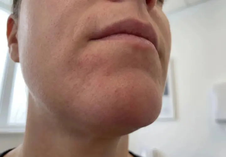 När perioral dermatit stressar huden runt munnen syns rodnad och små utslag.