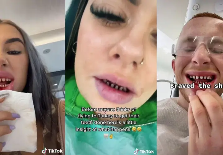 Trzy osoby po zabiegu stomatologicznym w Turcji. Widoczne są ich przygotowane do koron lub licówek zęby.