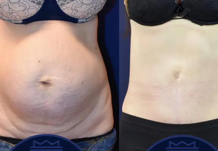 Före- och efterbilder visar tydliga fettsugning resultat på magen. Huden är slätare och midjan smalare.