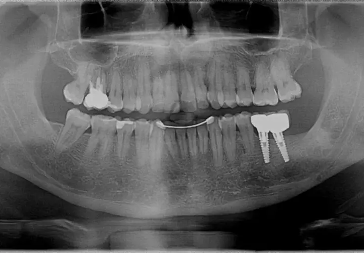 Radiografia panoramica dentale mostra impianti dentali e una protesi. Si nota una sacca gengivale in corrispondenza di un dente.