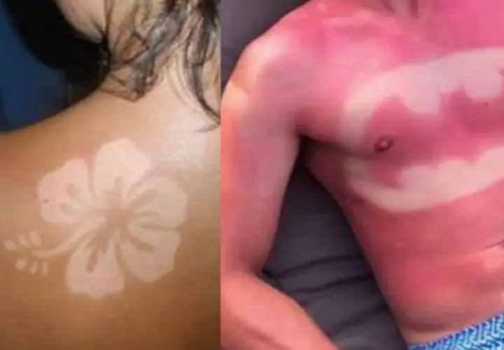 Un coup de soleil révèle un tatouage en forme de fleur d'hibiscus sur une épaule. Sur la droite, un autre coup de soleil dessine le symbole de Batman sur un torse.