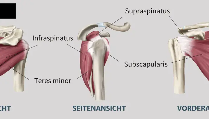 Schulteransichten: Rück-, Seiten- und Vorderansicht zeigen Muskeln wie Infraspinatus, Subscapularis und Teres minor. Bei Schmerzen im Teres minor ist eine genaue Diagnose wichtig.