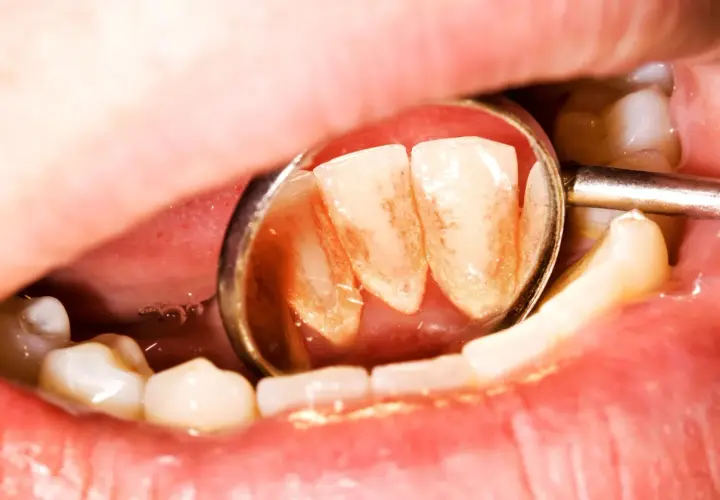 Widok zęba z kamieniem nazębnym w lustrze dentystycznym. Czy kamień nazębny śmierdzi? Tak, może powodować nieprzyjemny zapach.