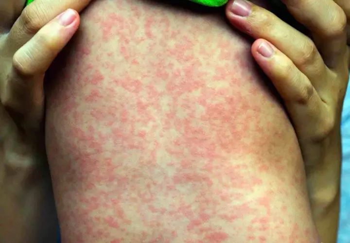 Macchie rosse sulla pelle bambini, un'eruzione cutanea diffusa che potrebbe richiedere attenzione medica.