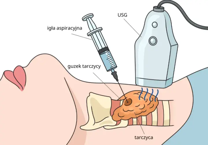 Badanie tarczycy: jak wygląda, przygotowanie, wyniki krok po kroku