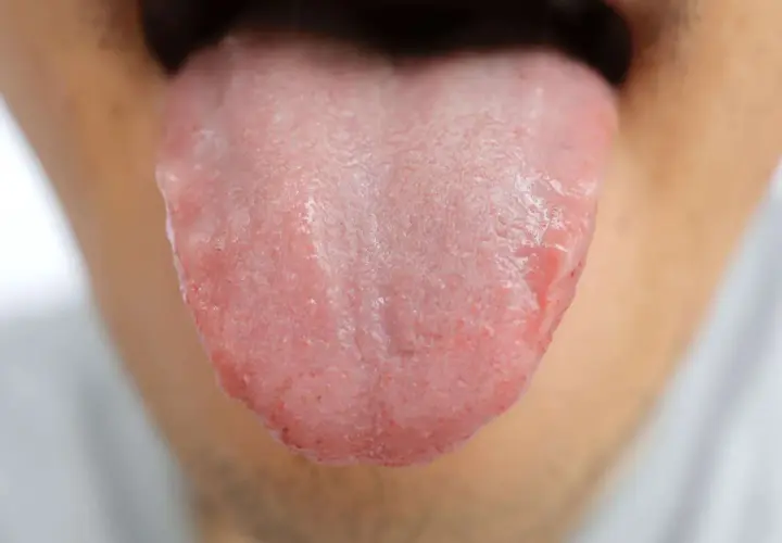 Lingua arrossata e irritata, con papille evidenti, che suggerisce un bruciore alla lingua.