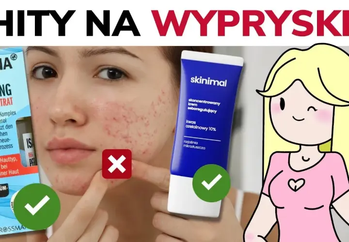 Czym smarować pryszcze? Skuteczne metody, by zniknęły szybko i bez śladu