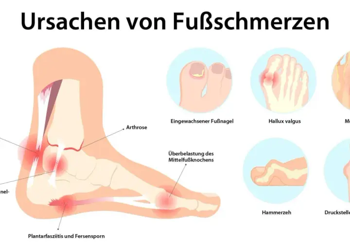 Illustration zeigt Ursachen von Fußschmerzen: Achillessehnenentzündung, Hallux valgus, Morton-Neuralgie, Hammerzeh, Fersensporn und mehr.