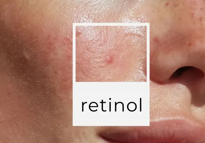Zbliżenie na skórę twarzy z niedoskonałościami. W ramce napis "retinol" sugeruje jego działanie na problemy skórne.