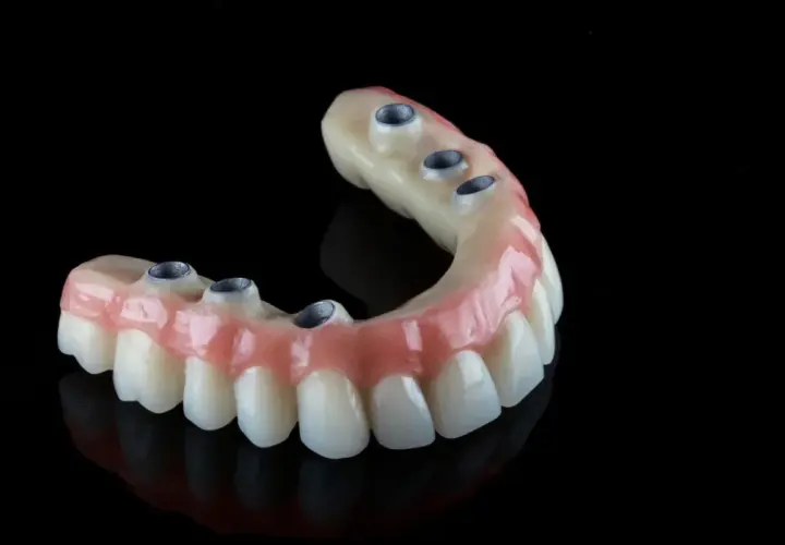 Protesi dentale mobile senza palato, con attacchi metallici per un sorriso fisso e naturale.