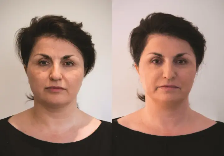 Porównanie twarzy kobiety przed i po zabiegu, ukazujące zmiany w wyglądzie.