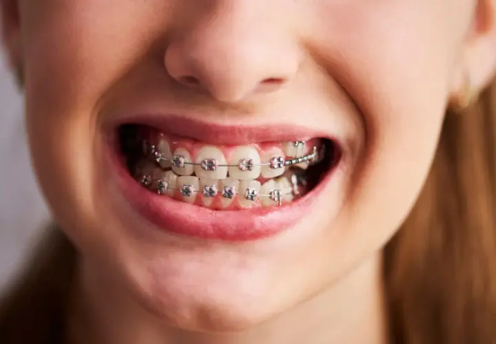 Uśmiechnięta twarz z aparatem ortodontycznym. Krótka wizyta u dentysty, a potem już tylko czekanie na efekt. Ile trwa zakładanie aparatu?