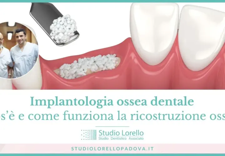 Ricostruzione ossea per implantologia dentale: due dentisti sorridono mentre un'immagine mostra il materiale per l'innesto osseo.