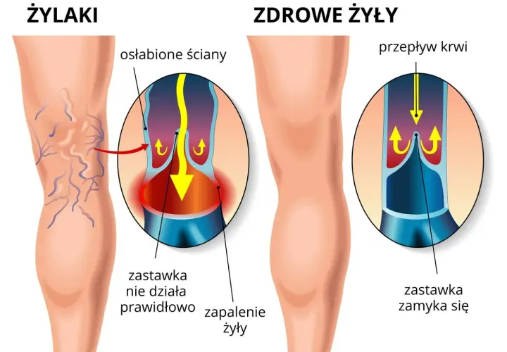 Porównanie żylaków i zdrowych żył. W żylakach zastawka nie działa, powodując zastój krwi. W zdrowych żyłach zastawka zamyka się prawidłowo.