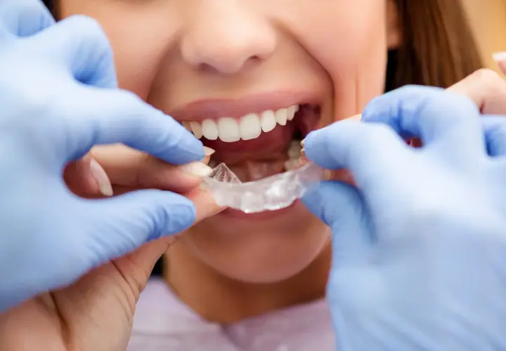 Manos con guantes azules colocan un alineador transparente. La sonrisa de la mujer muestra el progreso de su evolución Invisalign mes a mes.