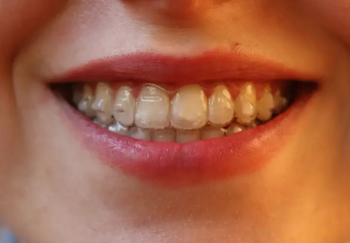 Sonrisa con alineadores transparentes, buscando blanquear Invisalign para una sonrisa radiante.