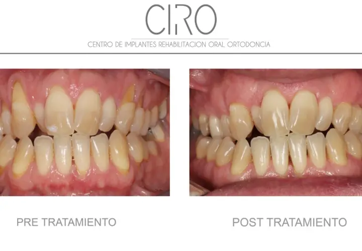 Comparación antes y después de un tratamiento de mantenimiento periodontal. Dientes amarillentos y encías inflamadas antes, y dientes limpios y encías sanas después.
