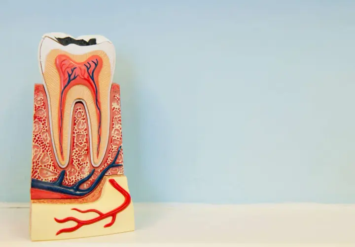 Modelo dental muestra caries profunda, exponiendo la pulpa dental. Se aprecian nervios y vasos sanguíneos.
