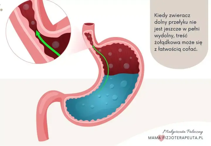 Ilustracja pokazuje cofanie się treści żołądkowej do przełyku, co jest typowe dla refluksu u niemowlaka.