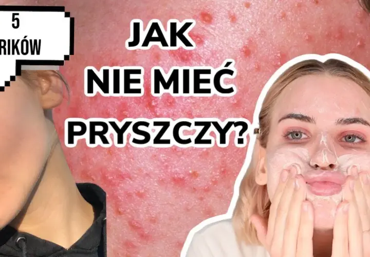 Gładka cera bez pryszczy? Odkryj sekrety eksperta!