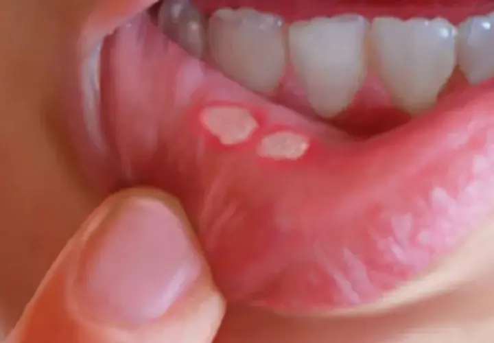 Afta a dentysta: Przełożyć wizytę czy iść? Jasne wskazówki.