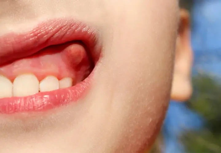 Primer plano de una boca infantil mostrando un bulto en la encía, cerca de los dientes frontales.