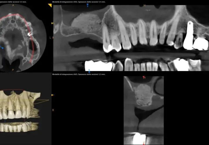 Immagini TC dentali che mostrano un rialzo seno mascellare prima e dopo, con innesto osseo e impianto dentale.