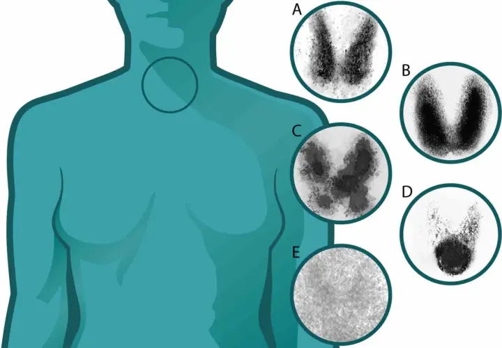 Imágenes de gammagrafía tiroidea que muestran la función de la glándula tiroides. El yodo para que sirve es fundamental para la producción de hormonas tiroideas.