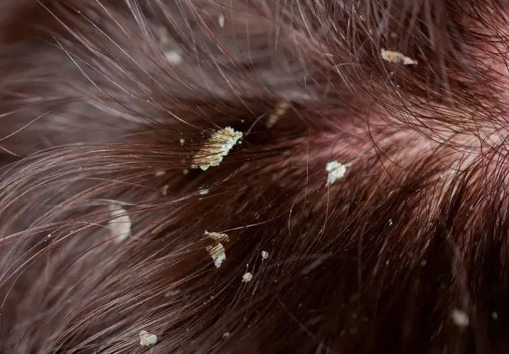 Primer plano de descamación cuero cabelludo con hebras de cabello castaño.