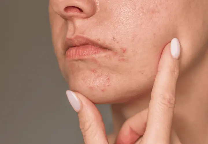 Närbild på munnen och hakan med rodnad och utslag, tecken på perioral dermatit. Solen kan förvärra tillståndet.