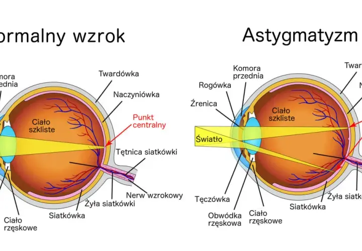 Porównanie oka z astygmatyzmem i normalnym wzrokiem. Astygmatyzm objawy: światło rozprasza się na siatkówce, zamiast skupiać w jednym punkcie.