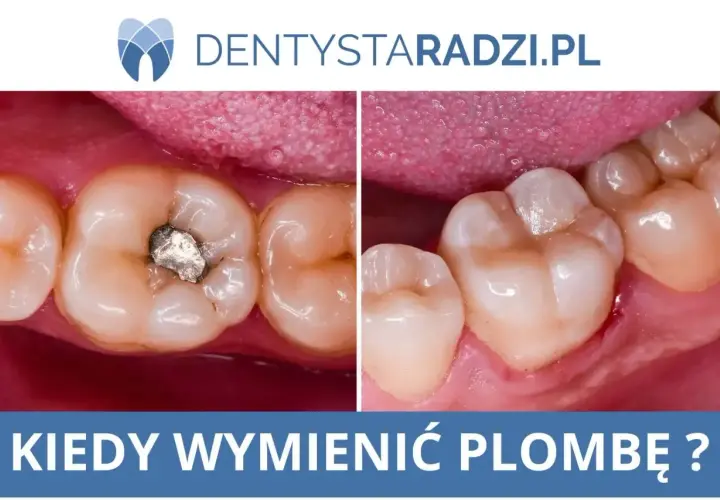 Porównanie zęba z amalgamatową plombą tymczasową i po jej wymianie na nową, estetyczną.