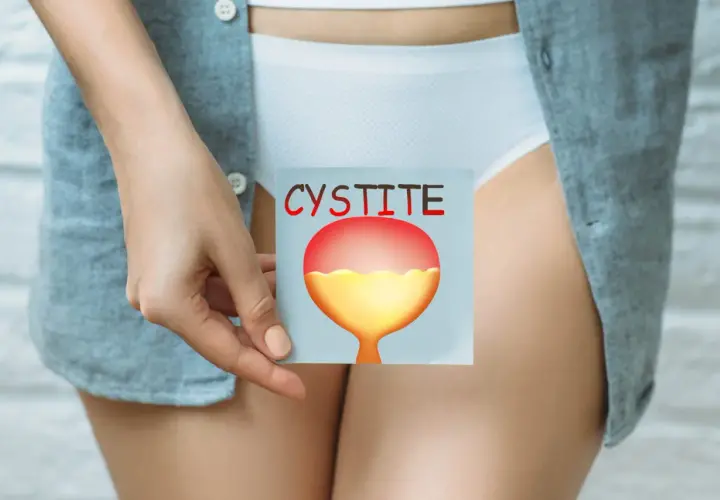 Une main tient une carte illustrant une vessie enflammée, avec le mot "CYSTITE" écrit en rouge. Cela peut aider à comprendre comment attraper une infection urinaire.