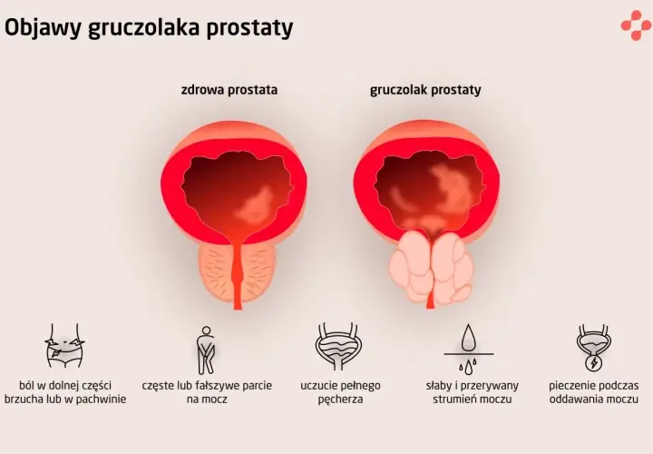 Porównanie zdrowej prostaty i gruczolaka prostaty. Objawy: ból, częste parcie, uczucie pełnego pęcherza, słaby strumień moczu, pieczenie.