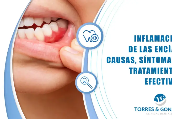 Primer plano de encías inflamadas, mostrando los síntomas de la gingivitis. Información sobre causas y tratamientos.